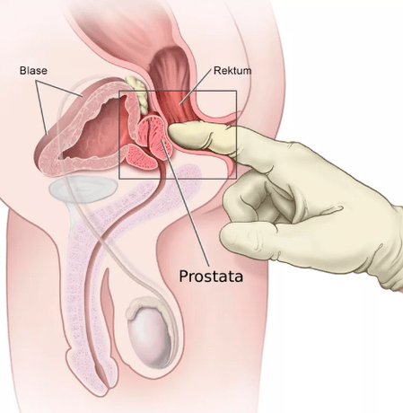 Massaggio alla prostata