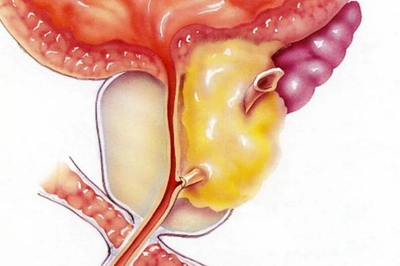 Infiammazione della prostata